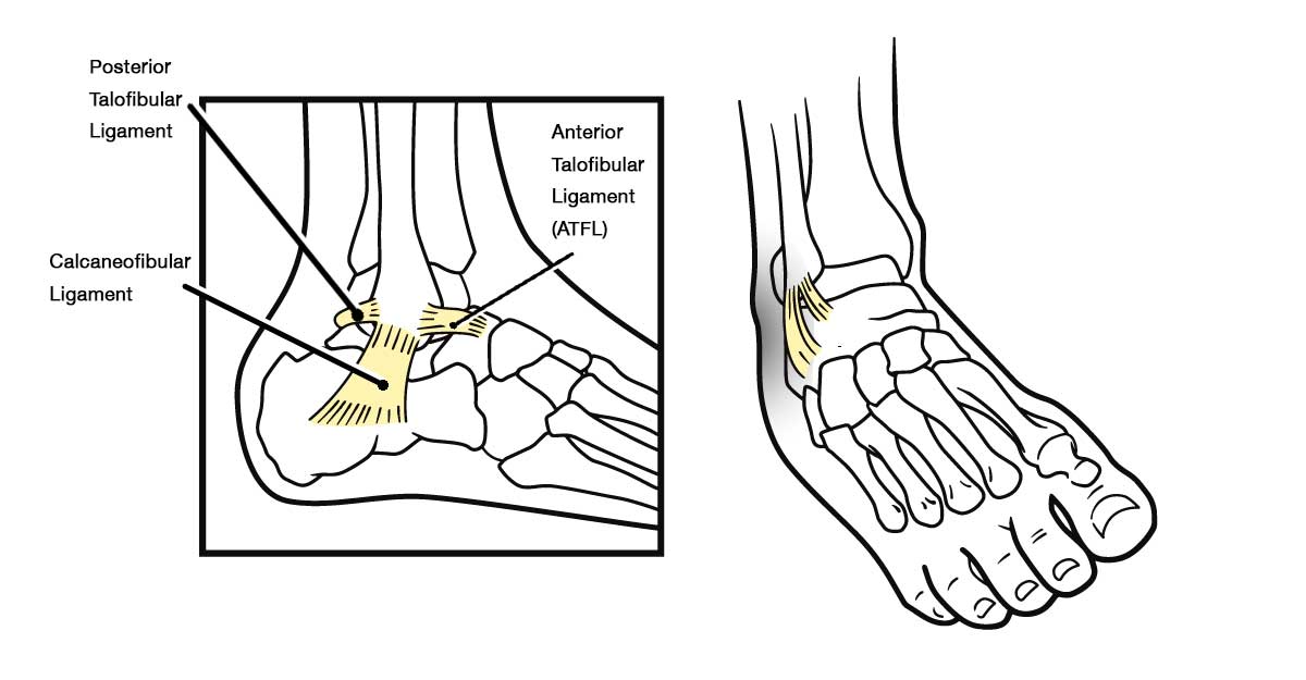 Basketball Injuries and Lateral Ankle Sprains IONA Physiotherapy